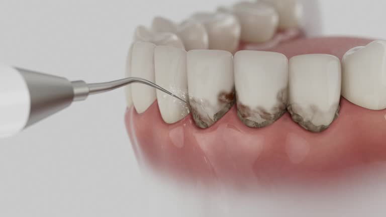 Trusted Wisdom Tooth Removal service in South Fulton, GA - Dentist Open Now
